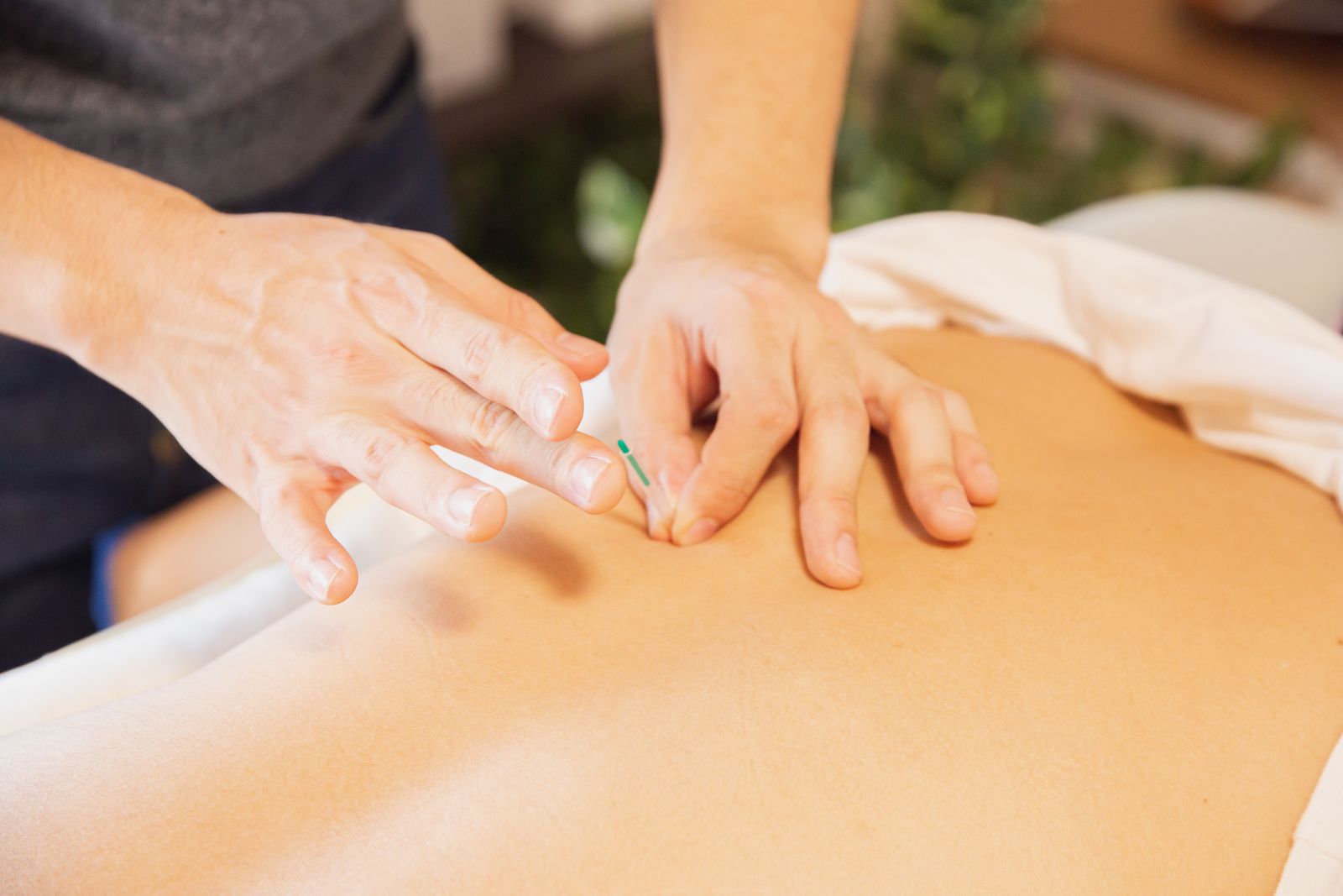 Dry needling treatment on a patient's lower back
